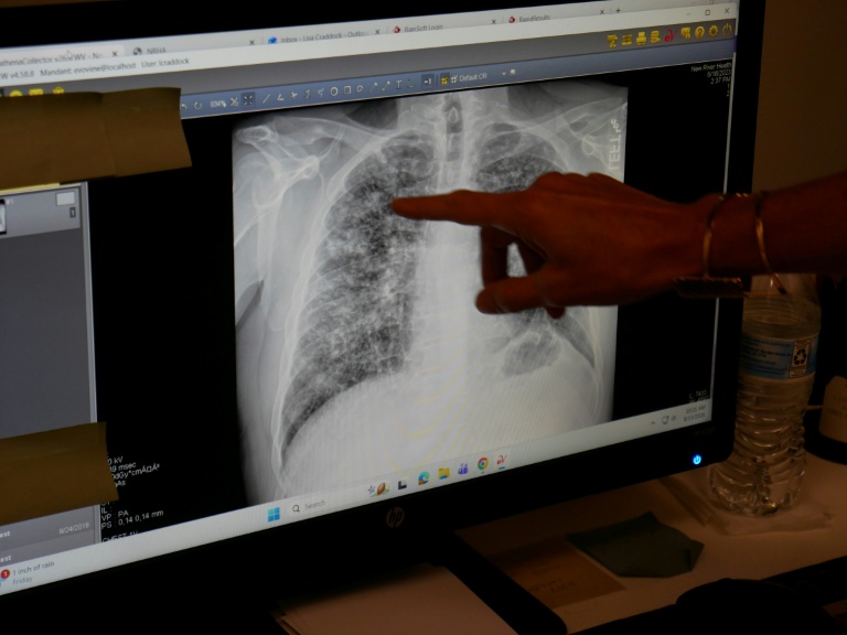 United States: 'Black lung disease' strikes miners once again