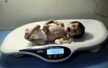 Une petite fille syrienne souffrant de malnutrition aiguë est pesée dans un hôpital de Hamouria, dans la Ghouta oriental