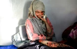 La Yéménite Al-Anoud Hussein Chariane, 19 ans, mariée à 12 ans, répudiée à 16 et défigurée à l'acide par son ex-mari, reçoit un traitement dans un hôpital de Sanaa, le 28 janvier 2021