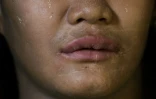 Le visage de Than Than Ei couvert de cicatrices, le 29 septembre 2016, à Rangoon
