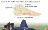 La star du PSG Neymar souffre d'une entorse à la cheville droite et d'une fissure sur un os du pied 