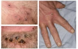 Montage photos diffusé le 22 juin 2022 par l'Agence de sécurité sanitaire britannique (UKHSA) montrant les lésions cutanées provoquées par la variole du singe 