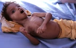 Un enfant souffrant de malnutrition allongé dans un lit d'hôpital, dans la province de Hajjah, dans le nord-ouest du Yémen, le 25 octobre 2018