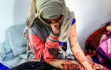La Yéménite Al-Anoud Hussein Chariane, 19 ans, mariée à 12 ans, répudiée à 16 et défigurée à l'acide par son ex-mari, reçoit un traitement dans un hôpital de Sanaa, le 28 janvier 2021