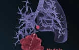 Nodule pulmonaire