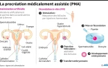 La procréation médicalement assistée