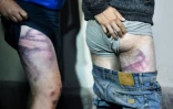 Des opposants à la réélection du président Loukachenko ontrent les traces de coups sur leur corps, après avoir été libérés de la prison d'Okrestina, le 14 août 2020 à Minsk, au Belarus