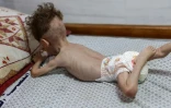 Un enfant palestinien souffrant de malnutrition est traité à l'hôpital Kamal Adwane de Beit Lahia, dans le nord de la bande de Gaza, le 9 juillet 2024