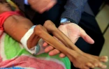 Un enfant yéménite souffrant de malnutrition reçoit des soins dans un hôpital de Sanaa le 6 octobre 2018