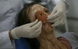 Un docteur fait un essai avec une prothèse oculaire sur Denise Vicentin, à l'hôpital de Sao Paulo, le 1er novembre 2019