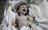Un enfant syrien souffrant de sévère malnutrition dans une clinique de Hammouriyé dans la région rebelle de la Ghouta orientale, assiégée depuis 2013, le 21 octobre 2017