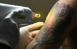 Sandi Widodo travaille sur un client musulman qui souhaite effacer ses tatouages, le 18 avril 2018 à Jakarta, en Indonésie