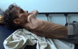 Un enfant de 10 ans souffrant de famine le 19 novembre à Taez dans le pays en guerre.