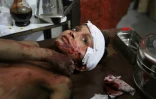 Un garçon est soigné le 7 mars 2018 dans un hôpital de fortune de l'enclave rebelle dans la Ghouta orientale, bombardée par les forces du régime syrien 