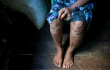 Than Than Ei montre des cicatrices sur ses jambes causées par les maltraitances dont elle a fait l'objet lorsqu'elle était esclave, le 29 septembre 2016, à Rangoon