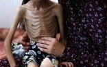 Une fillette souffrant de malnutrition sur les genoux de sa mère, le 2 août 2025 à Gaza 