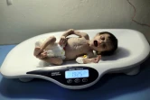 Une petite fille syrienne souffrant de malnutrition aiguë est pesée dans un hôpital de Hamouria, dans la Ghouta oriental