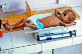 Un enfant yéménite souffrant de malnutrition est pesé dans un hôpital de la capitale yéménite Sanaa, le 6 octobre 2018