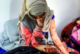 La Yéménite Al-Anoud Hussein Chariane, 19 ans, mariée à 12 ans, répudiée à 16 et défigurée à l'acide par son ex-mari, reçoit un traitement dans un hôpital de Sanaa, le 28 janvier 2021 