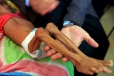 Un enfant yéménite souffrant de malnutrition reçoit des soins dans un hôpital de Sanaa le 6 octobre 2018
