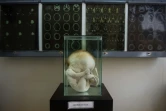 Un foetus humain atteint d'une pathologie cérébrale, l'hydrocéphalie, au musée de neuropathologie de Lima, le 16 novembre 2016