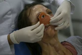 Un docteur fait un essai avec une prothèse oculaire sur Denise Vicentin, à l'hôpital de Sao Paulo, le 1er novembre 2019