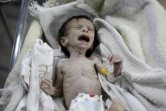 Un enfant syrien souffrant de sévère malnutrition dans une clinique de Hammouriyé dans la région rebelle de la Ghouta orientale, assiégée depuis 2013, le 21 octobre 2017