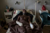 Un blessé est soigné de brulures à l'hôpital de Jos, le 28 juin 2018, après un massacre dans le centre du Nigeria.

