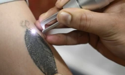 Une personne se fait retirer un tatouage au laser dans une clinique de Srinagar, au Cachemir indien, le 22 avril 2025 ( AFP / Tauseef MUSTAFA )