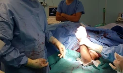 L'opération de la double réimplantation des bras d'une femme de 30 ans, le 24 août 2017 au CHU de Grenoble