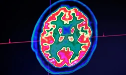 Des médecins ont constaté chez des malades graves du Covid-19 des symptômes neurologiques allant de la perte d'odorat à des douleurs nerveuses, et jusqu'à des crises convulsives et des accidents vasculaire cérébraux (AVC).