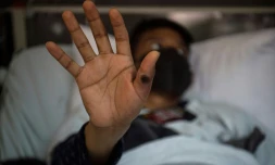 Un patient montre sa main portant une lésion due au mpox, le 16 août 2022 à Lima, au Pérou