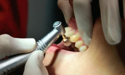 Le procès du Néerlandais Jacobus Marinus - dit Mark - Van Nierop, surnommé le "dentiste de l'horreur" pour avoir mutilé une centaine de patients dans la Nièvre, s'ouvre devant le tribunal correctionnel de Nevers