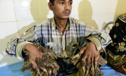 Abul Bajandar, 26 ans, au Dhaka Medical College Hospital Ă Dacca le 31 janvier 2016