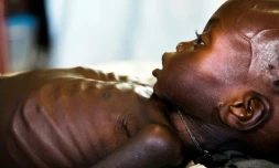 Agop Manut, un bébé de onze mois souffrant de malnutrition, est soigné dans une clinique de Médecins sans frontières, le 11 octobre 2016 à Aweil, au Soudan du Sud