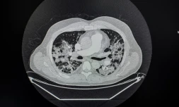 Un scanner de poumons d'un patient infecté par le Covid-19