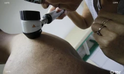 dépistage cancer de la peau