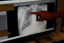 Lisa Emery, directrice du Breathing Center and Black Lung Clinic; montre une radiographie des poumons d'un mineur de charbon souffrant de pneumoconiose, le 13 août 2026 au New River Health, à Oak Hill, en Virginie-Occidentale