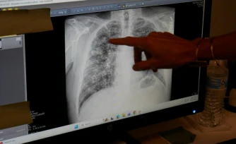 Lisa Emery, directrice du Breathing Center and Black Lung Clinic; montre une radiographie des poumons d'un mineur de charbon souffrant de pneumoconiose, le 13 août 2026 au New River Health, à Oak Hill, en Virginie-Occidentale 