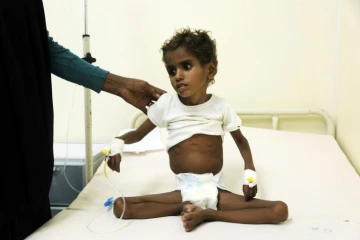 Une enfant mal-nourrie hospitalisée au Yemen, le 5 novembre 2017