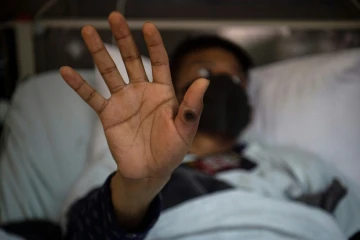 Un patient montre sa main portant une lésion due au mpox, le 16 août 2022 à Lima, au Pérou