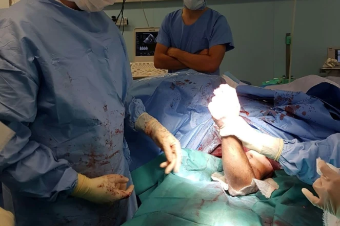 L'opération de la double réimplantation des bras d'une femme de 30 ans, le 24 août 2017 au CHU de Grenoble