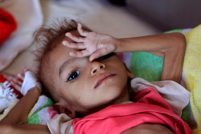 Un enfant yéménite souffrant de malnutrition. Photo prise le 6 octobre 2018 dans un hôpital de Sanaa