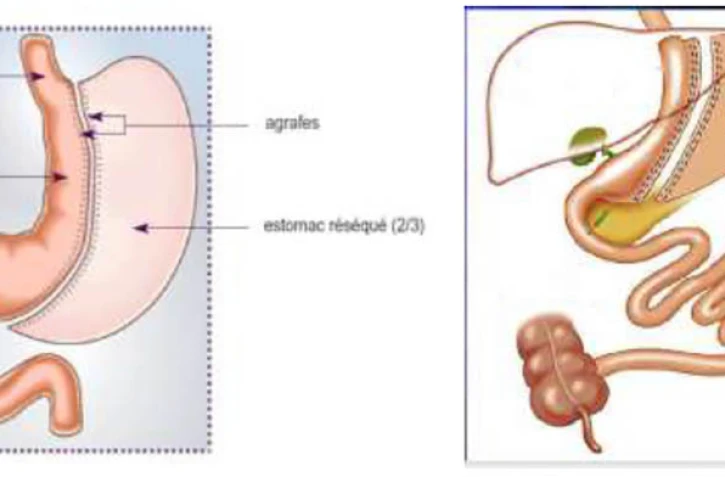 Sleeve gastrectomy