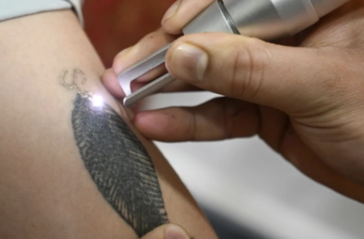 Une personne se fait retirer un tatouage au laser dans une clinique de Srinagar, au Cachemir indien, le 22 avril 2025 ( AFP / Tauseef MUSTAFA )
