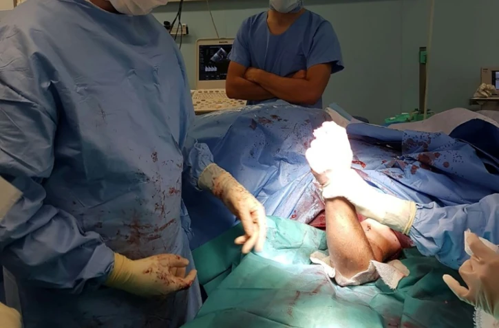 L'opération de la double réimplantation des bras d'une femme de 30 ans, le 24 août 2017 au CHU de Grenoble