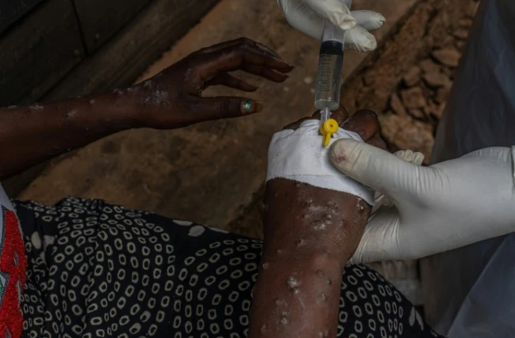 Une patiente atteinte du mpox reçoit un traitement en intraveineuse à l'hôpital de Kavumu, au nord de Bukavu, dans l'est de la RDC, le 24 août 2024