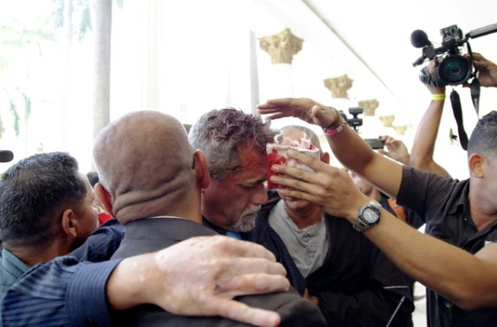 Le député d'opposition au gouvernement Maduro, Americo De Grazia (C), blessé à la tête par les manifestants qui ont fait irruption dans le parlement, le 5 juillet 2017 à Caracas