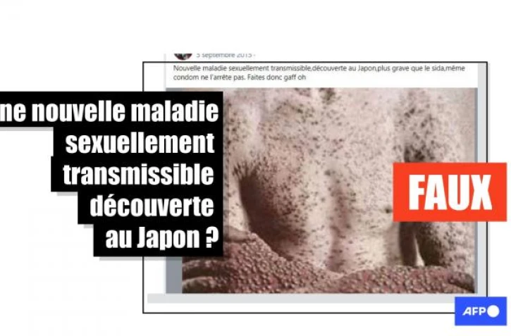   Non, une nouvelle MST, "plus grave que le sida", n&rsquo;a pas été découverte au Japon