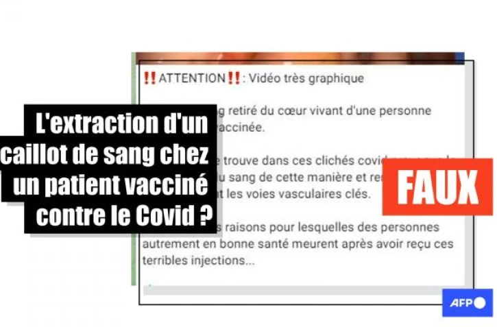   Cette vidéo ne montre pas l'extraction d'un caillot de sang chez un patient vacciné contre le Covid